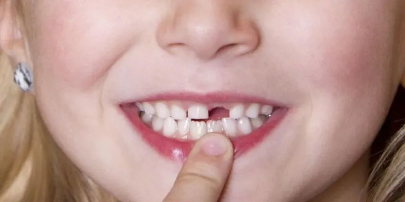 Tìm ý nghĩa khi mơ thấy rụng răng giả